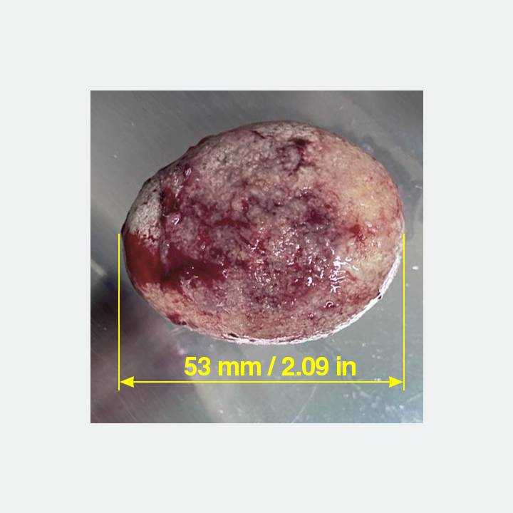 นิ่วก้อนใหญ่ของลาเต้